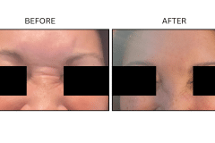 LB Neurotx Relx Glabellar Frown Lines - Patient16a