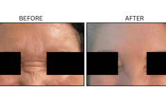 LB Neurotx Relx Glabellar Frown Lines - Patient16b