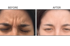 LB Neurotx Relx Glabellar Frown Lines - Patient17