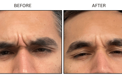 LB Neurotx Relx Glabellar Frown Lines - Patient3