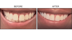 LB Neurotx Relx Gums - Patient2