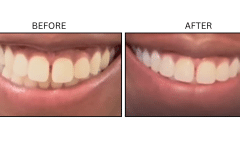 LB Neurotx Relx Gums - Patient2