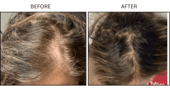 LB PRP HAIR FEMALE - Patient6
