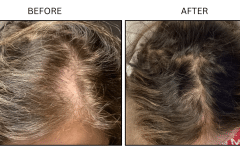 LB PRP HAIR FEMALE - Patient6