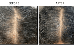 LB Medical Hair Loss - Patient11