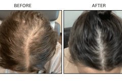 LB Medical Hair Loss - Patient12