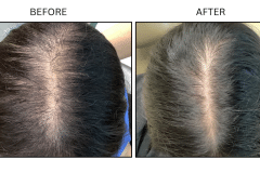 LB Medical Hair Loss - Patient13