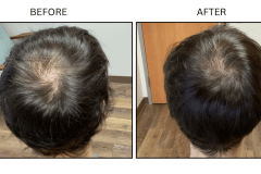 LB Medical Hair Loss - Patient14