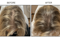 LB Medical Hair Loss - Patient15