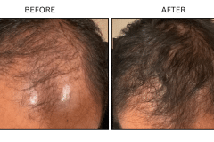 LB Medical Hair Loss - Patient8