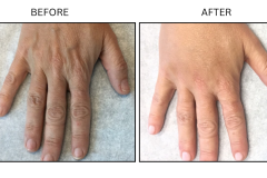 LB Fillers Hands - Patient3