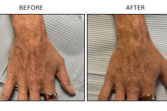 LB Fillers Hands - Patient4