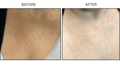 LB Lasers IPL - Patient14a