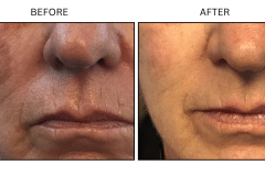 LB Lasers IPL - Patient10