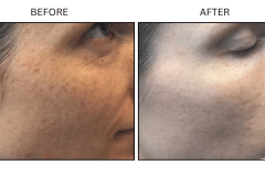 LB Lasers IPL - Patient11