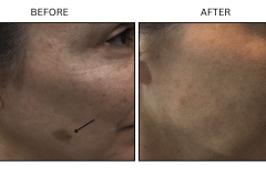 LB Lasers IPL - Patient12