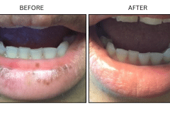 LB Lasers IPL - Patient13