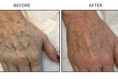 LB Lasers IPL - Patient6