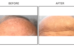 LB Lasers IPL - Patient7