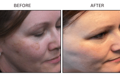 LB Lasers IPL - Patient8