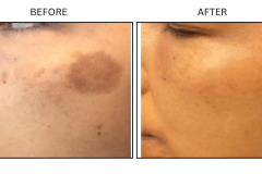 LB Lasers IPL - Patient9