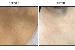 LB Lasers IPL - Patient14a