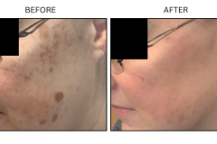 LB Lasers IPL - Patient14b