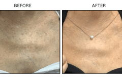 LB Lasers IPL - Patient15