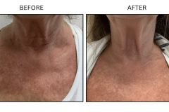 LB Lasers IPL - Patient16