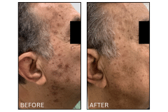 LB Lasers IPL - Patient17