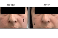 LB Lasers IPL - Patient18