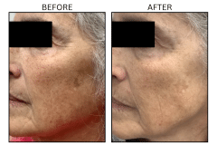 LB Lasers IPL - Patient19