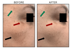 LB Lasers IPL - Patient20