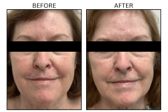 LB Lasers IPL - Patient21