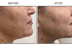 Lasers IPL - Patient2a