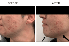 LB Fillers Jawline - Patient3