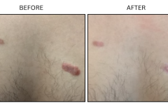 LB Surgical Keloids - Patient1