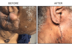 LB Surgical Keloids - Patient10