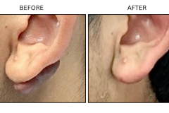 LB Surgical Keloids - Patient2a