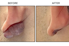 LB Surgical Keloids - Patient2b