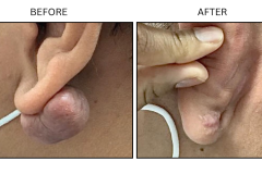 LB Surgical Keloids - Patient3