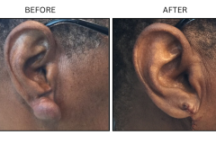 LB Surgical Keloids - Patient4