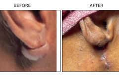LB Surgical Keloids - Patient5