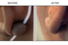 LB Surgical Keloids - Patient6