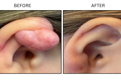 LB Surgical Keloids - Patient7