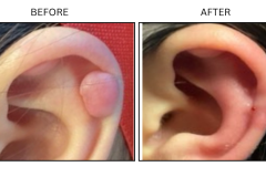 LB Surgical Keloids - Patient8