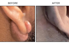 LB Surgical Keloids - Patient9a
