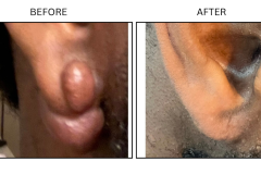 LB Surgical Keloids - Patient9b