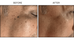 LB Medical Keratoses - Patient1