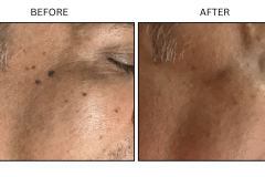 LB Medical Keratoses - Patient1